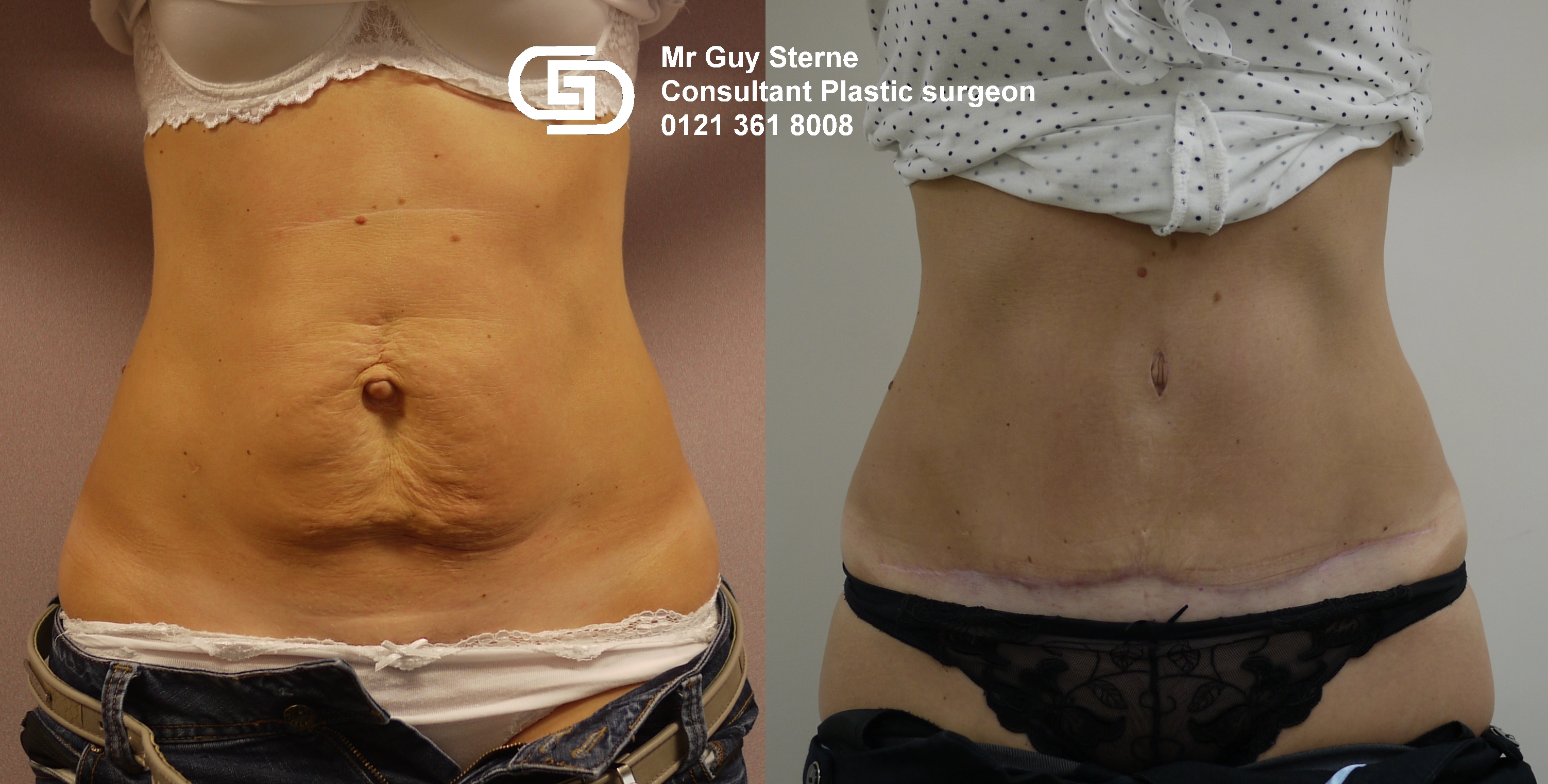 Abdominoplasty Tummy Tuck Surgery With Guy Sterne